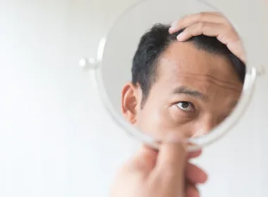Jak dbać o włosy po przeszczepie włosów?